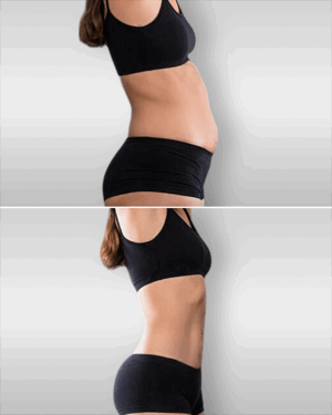 LIPO 4 ZONAS CON  TECNOLOGÍA HEUS